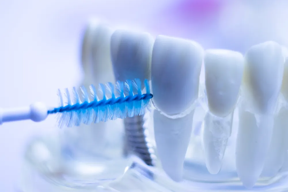 ຜົນປະໂຫຍດຂອງແປງ Interdental ສໍາລັບແຂ້ວ